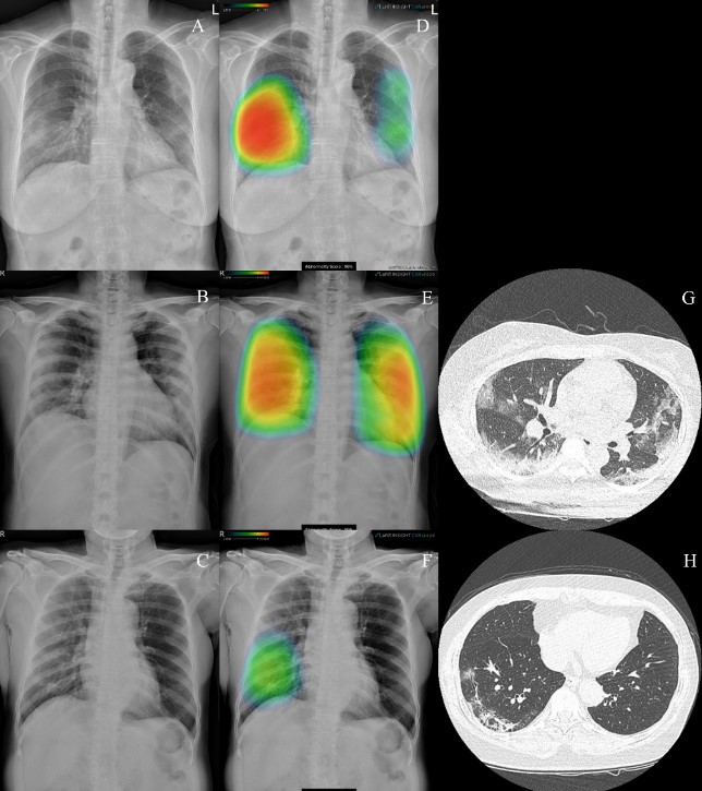 루닛 인사이트 CXR를 활용해 코로나19 폐렴이 표시된 흉부 엑스레이